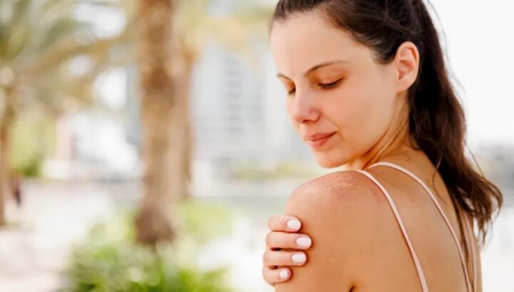 How sunburn increases the risk of skin cancer